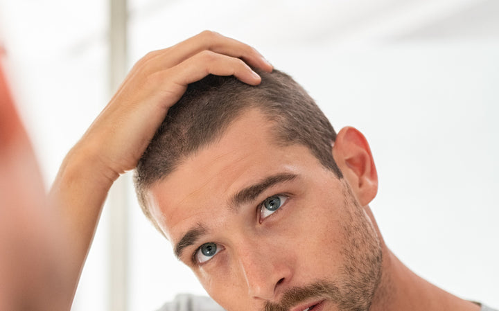 Does Vitamin Deficiency Cause Hair Loss? Young man looking at his receding hairline
